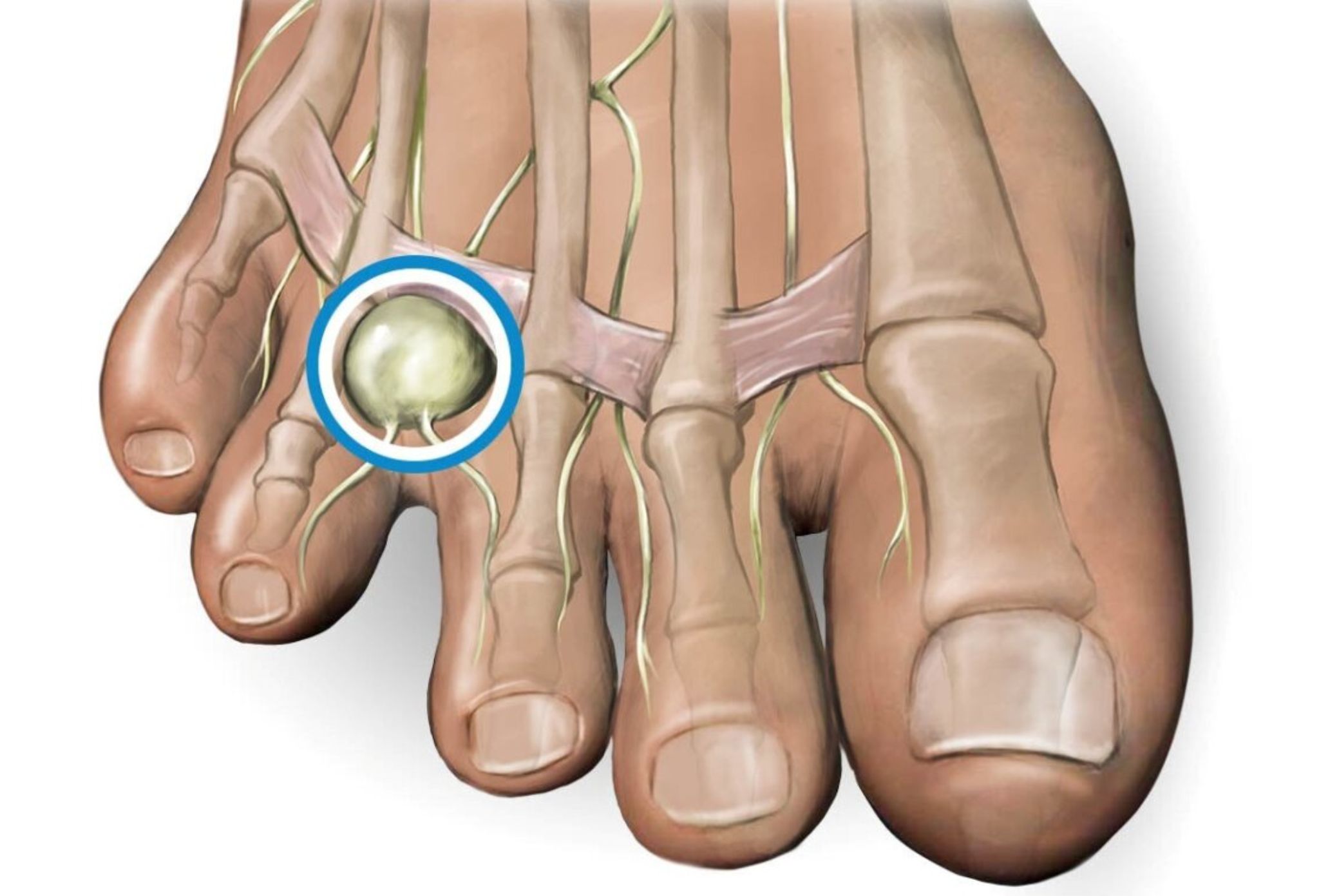 neuroma de morton