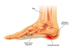espolon y fascitis plantar