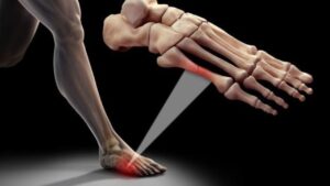 Cómo evitar el síndrome de sobrecarga metatarsal