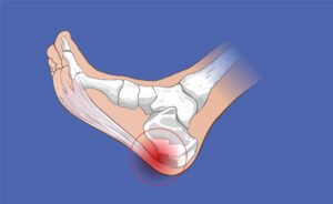 calzado fascitis plantar