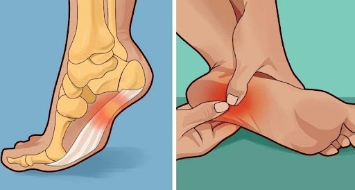 síntomas fascitis plantar